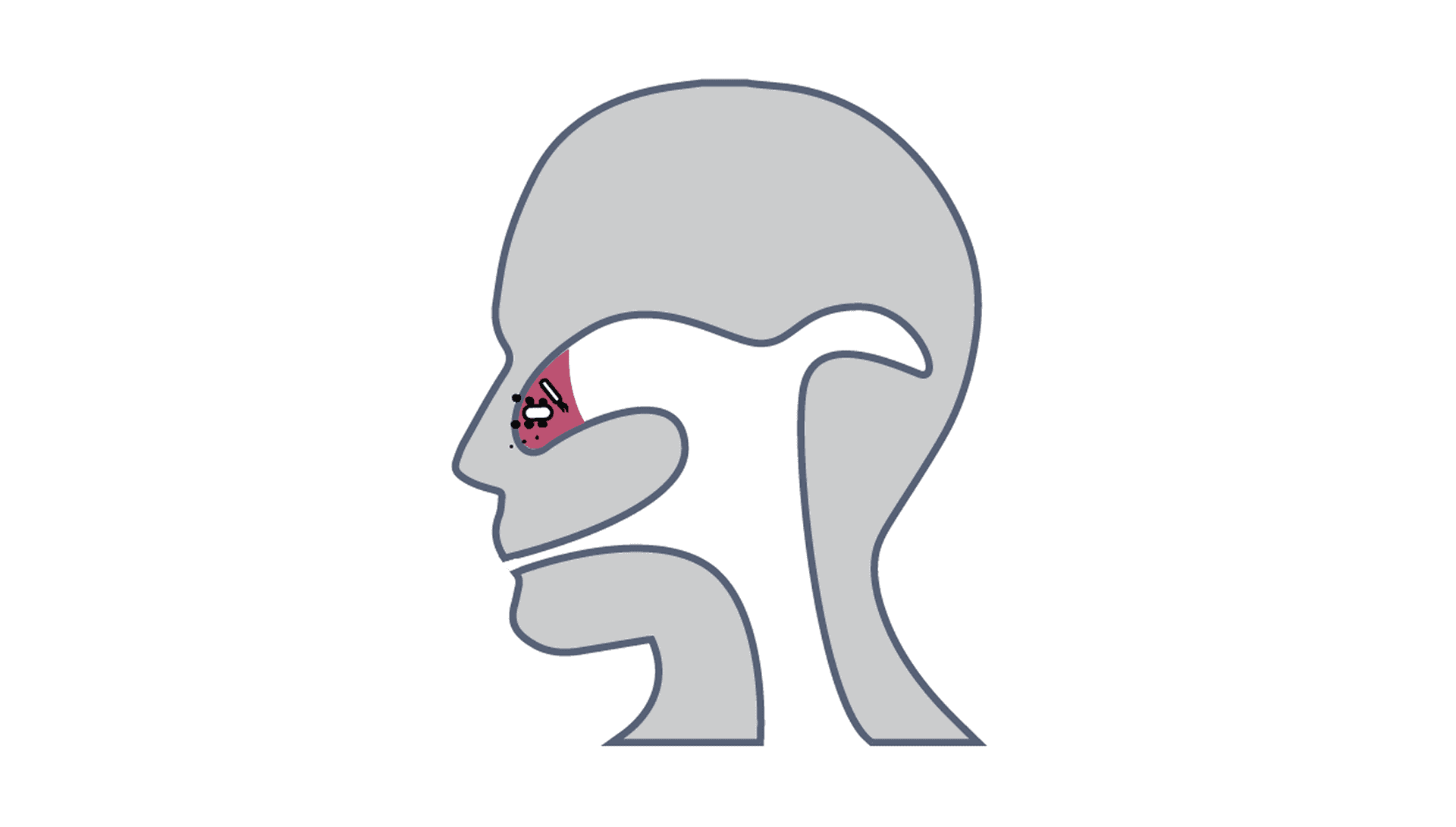 ENT chronic sinusitis image