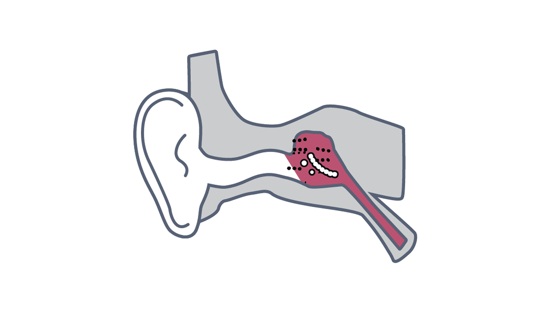 ENT fungal infection image