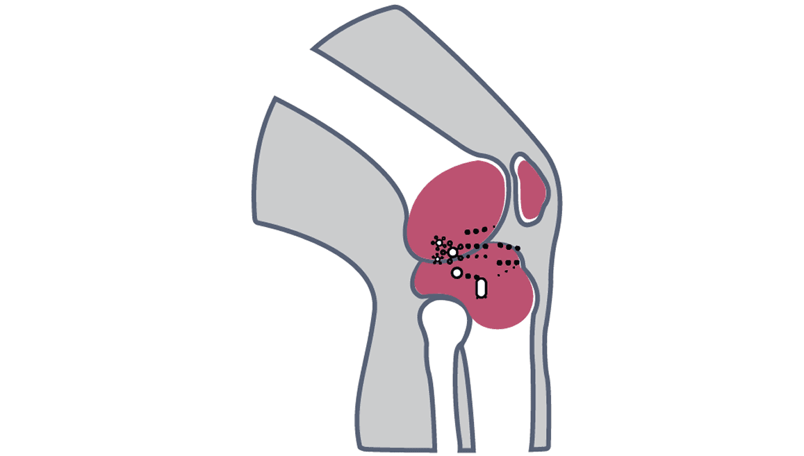 NGS identifies Kocuria missed by MALDI-TOF in joint infection Image