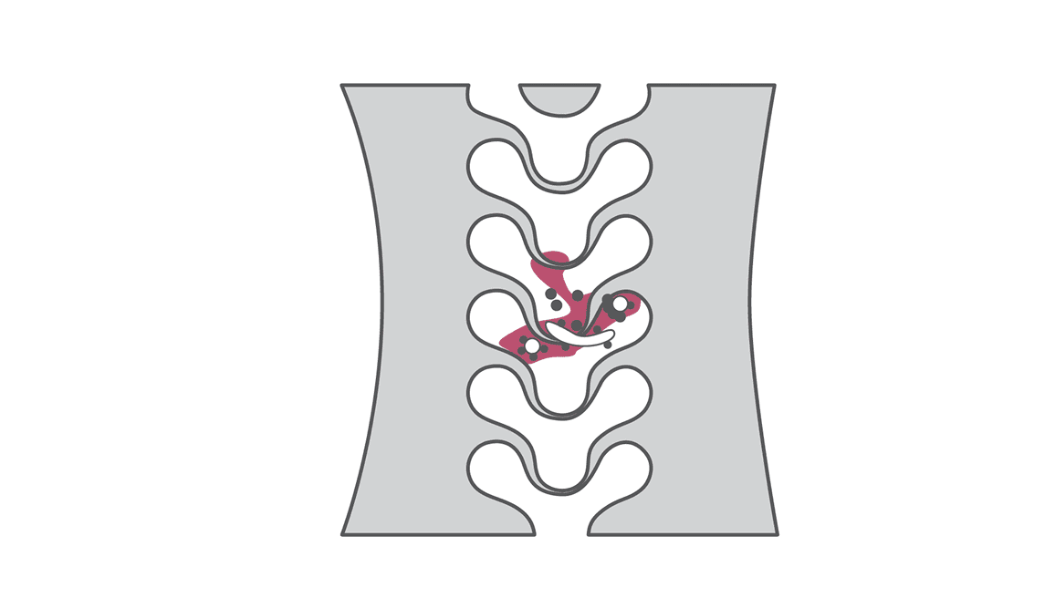NGS quickly identifies Mycobacterium smegmatis in spine implant infection Image