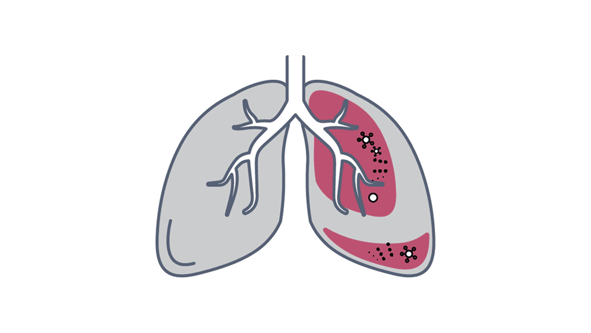 Fungal infection image