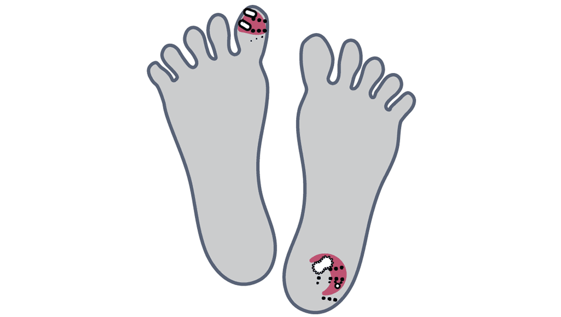 Wound leg ulcer image